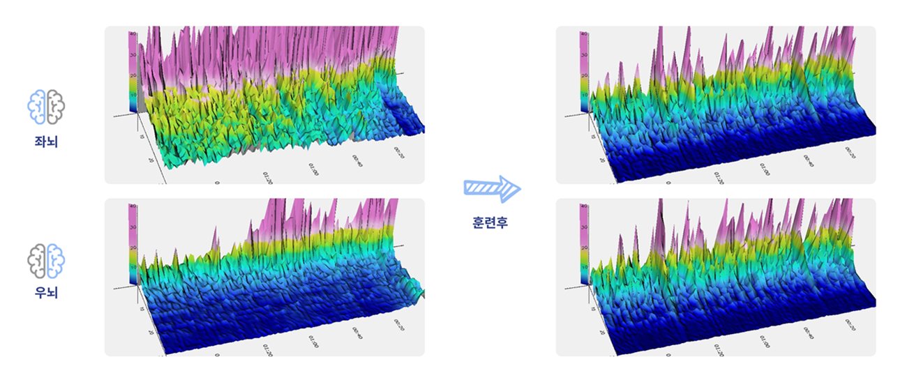두비전 훈련 전과 후의 실제 뇌파 변화 (좌뇌·우뇌)